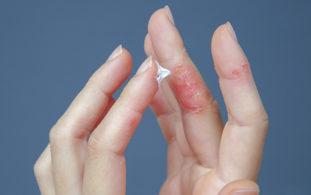 dermatitis.jpg